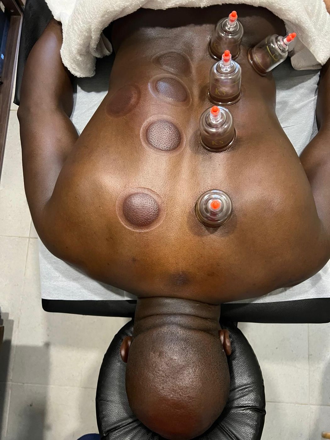 Cupping on the upper back