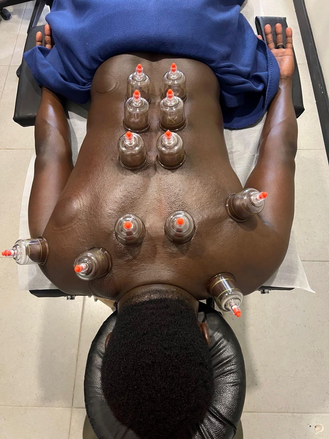 Cupping treatment on a client's back