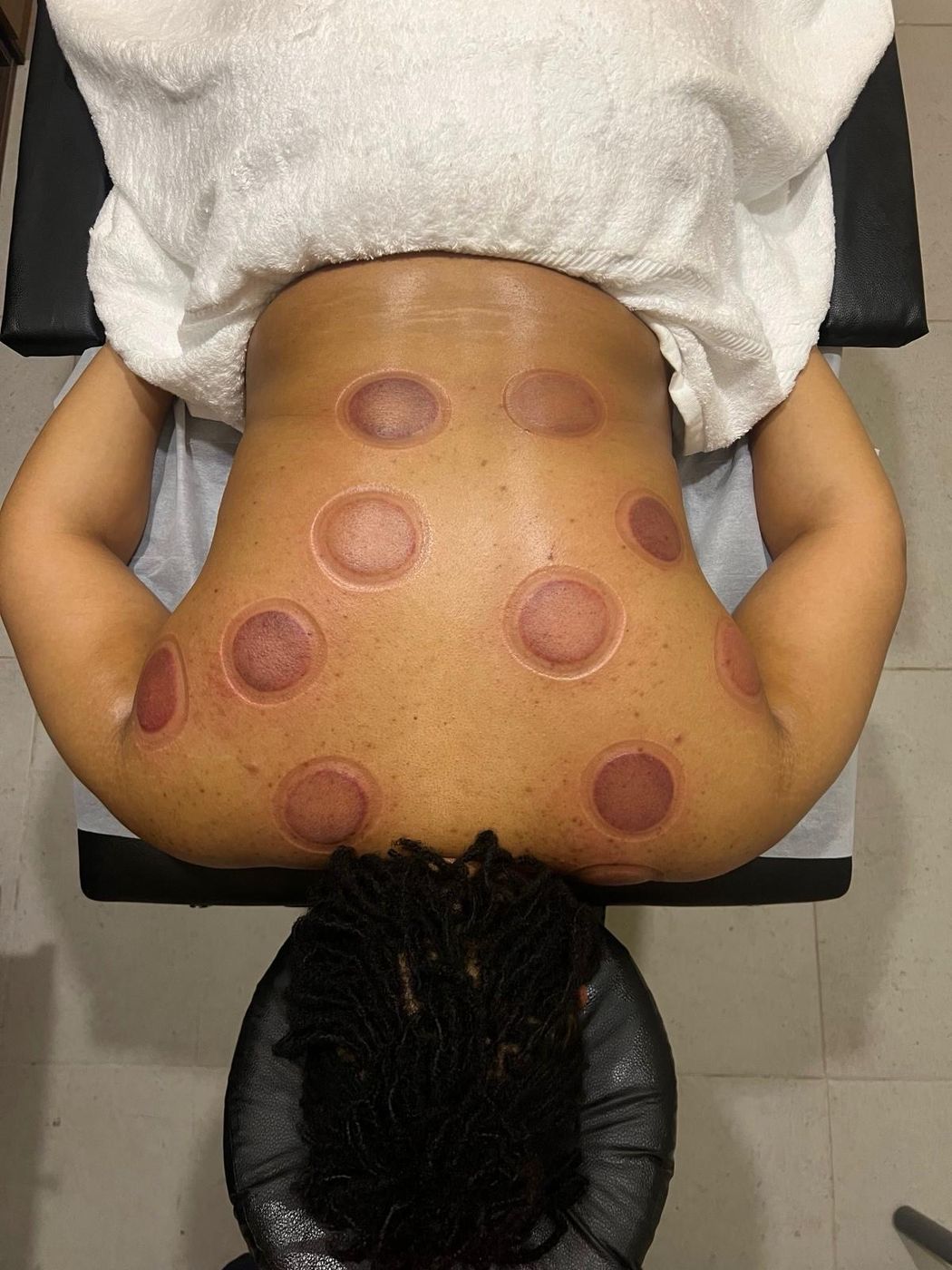 Back after a cupping session